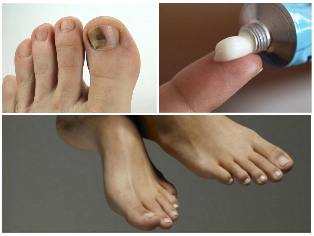 gljiva noktiju na nogama masti