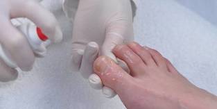 noktiju gljiva kako liječiti
