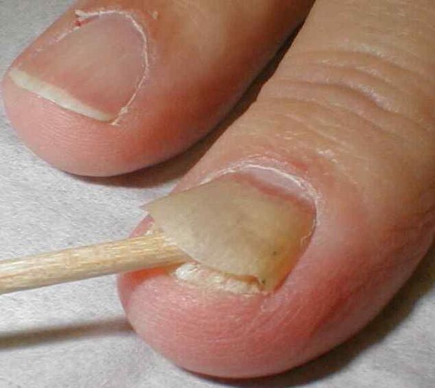 guljenje nokta gljivicom na noktima