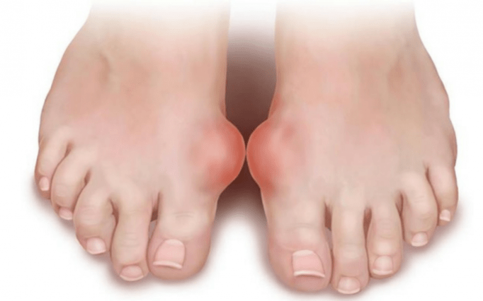 deformacija stopala kao uzrok pojave gljivica na nogama