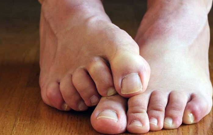 simptomi skvamoznih gljivica na stopalima