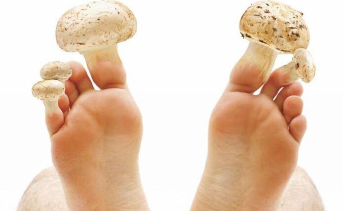 uzroci, simptomi i liječenje gljivica stopala
