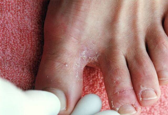 simptomi gljivice između prstiju na nogama