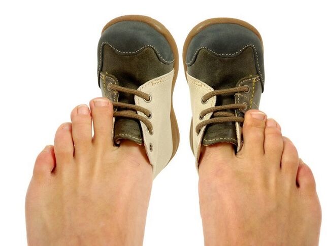 uske cipele kao uzročnik gljivica između prstiju