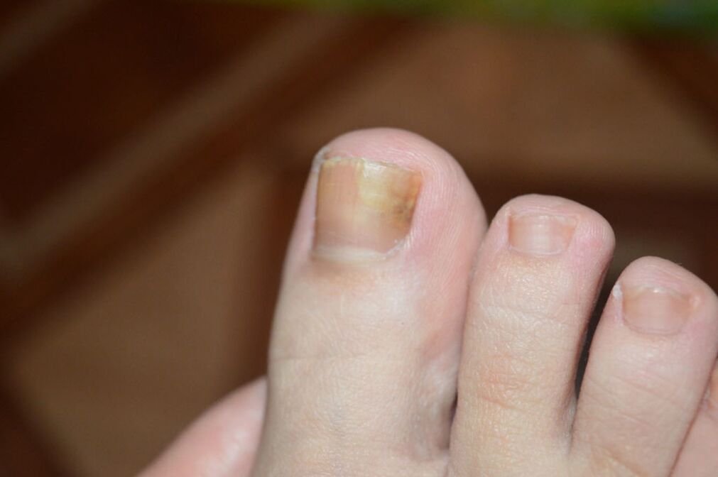 Početna faza gljivice na noktima nogu