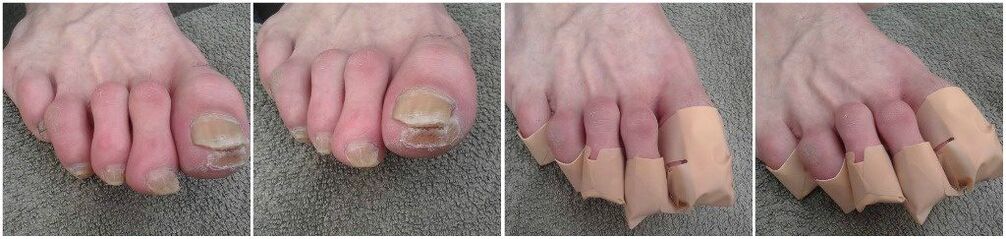 Primjena flastera za gljivice na noktima nogu