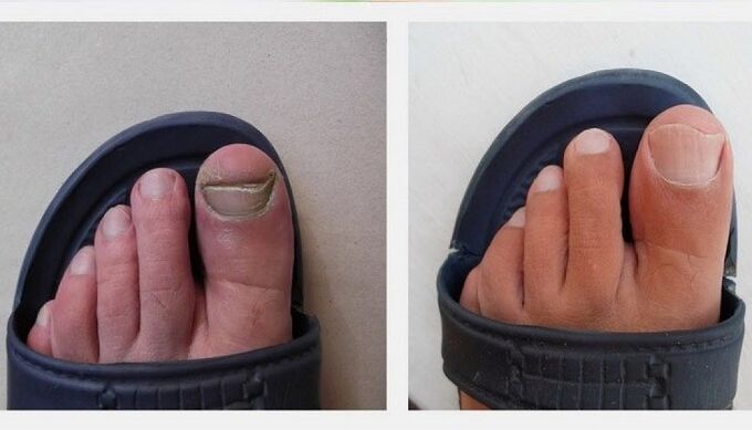 nokti na nogama prije i poslije liječenja gljivica jabučnim octom