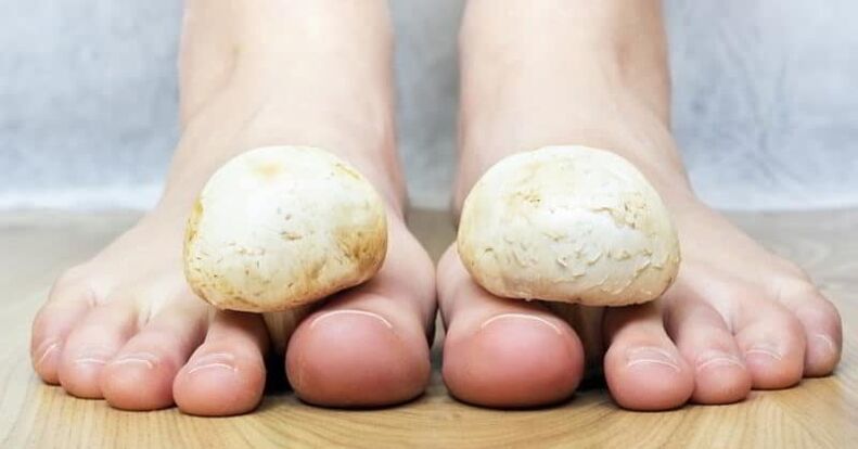 gljivice na koži stopala