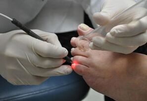 Lasersko liječenje gljivica na noktima nogu