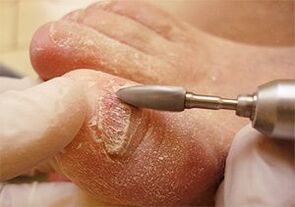 Mehaničko uklanjanje ploče nokta za onikomikozu