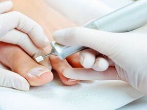 Terapeutska pedikura za gljivice noktiju na nogama