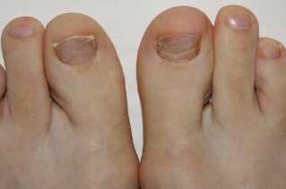 Simptomi pojave gljivica na nogama